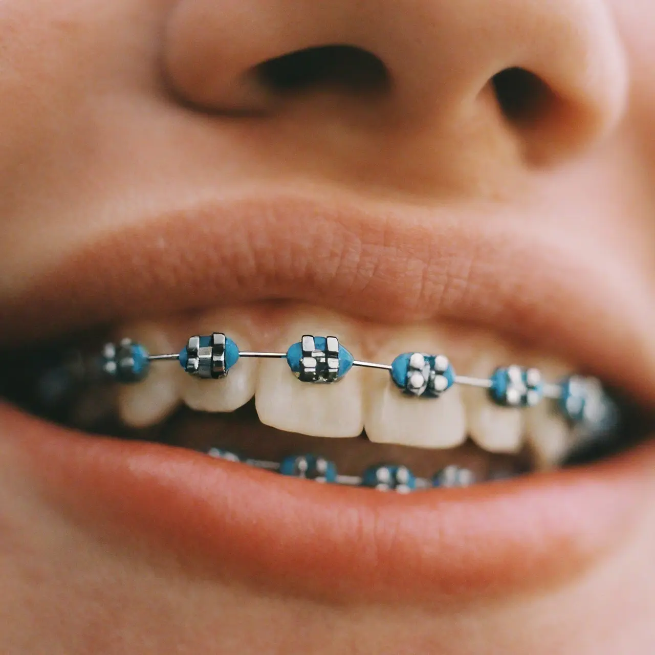 A close-up of a bright, smiling mouth with braces. 35mm stock photo
