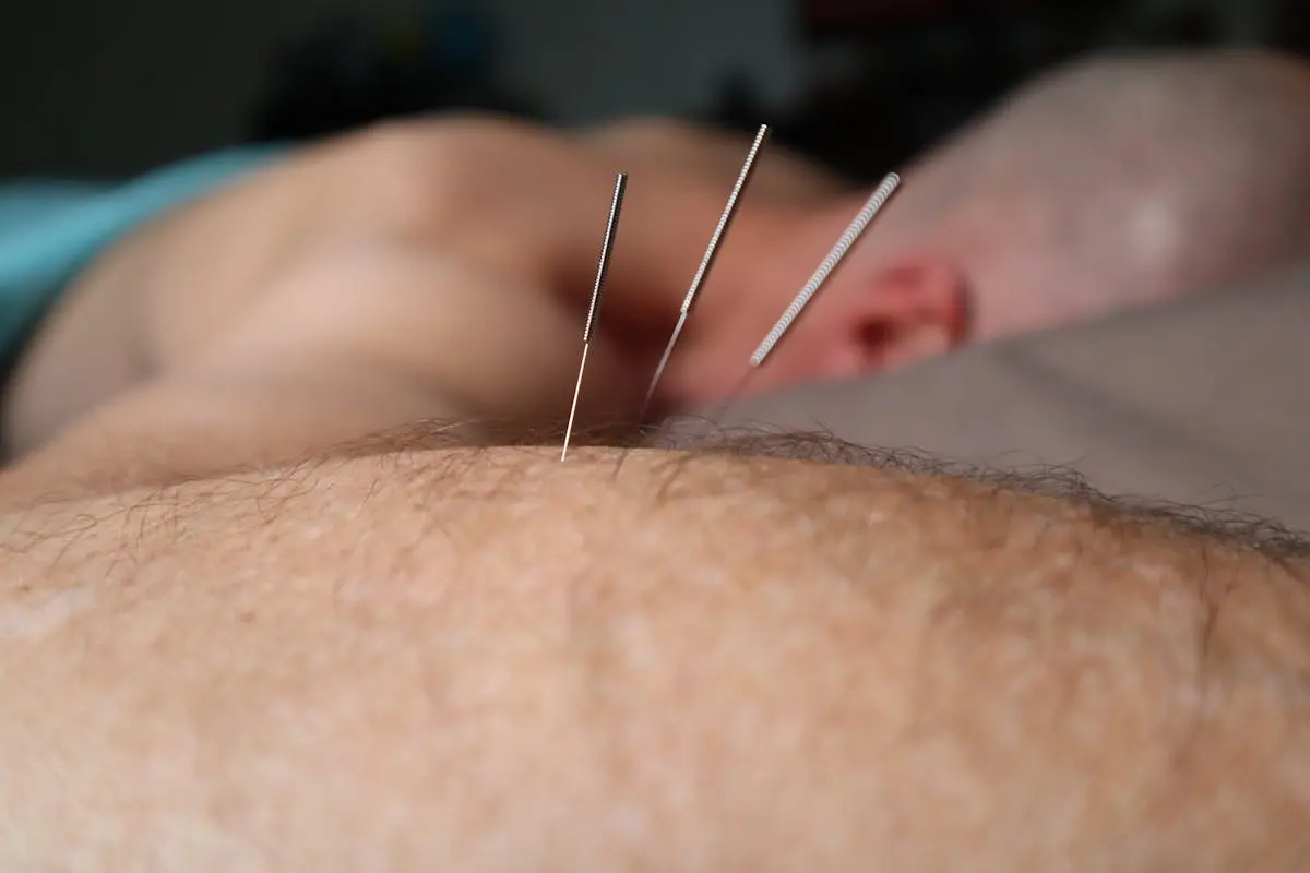 Close-up of acupuncture needles during a therapy session, focusing on skin and relaxation.